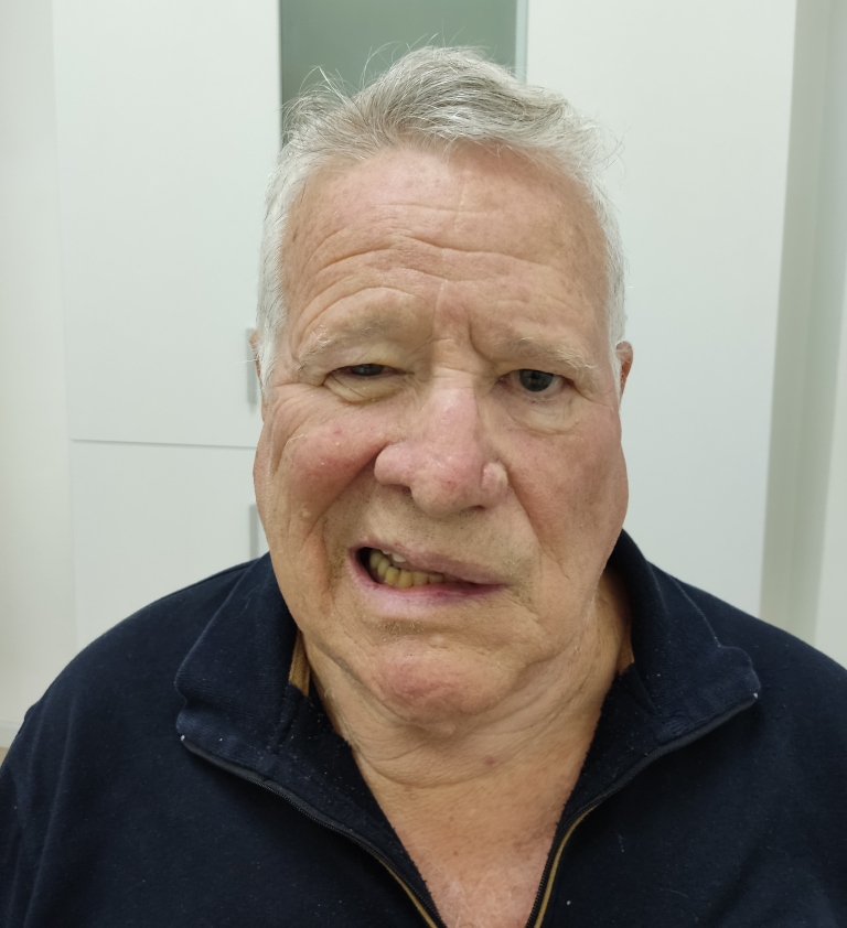 פציאליס שיתוק עצב הפנים